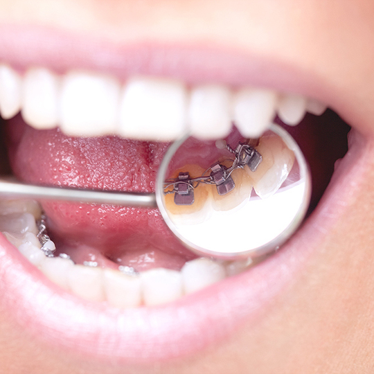 矯正歯科・矯正治療 - 三瀬歯科医院（松山市・松山市駅）